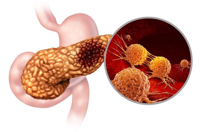 Viêm tụy là một căn bệnh phổ biến