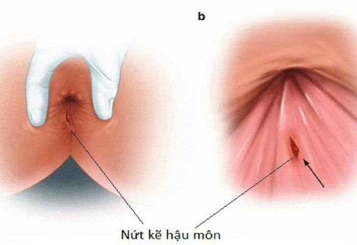 Nứt hậu môn có thể dẫn đến sự nhiễm trùng.