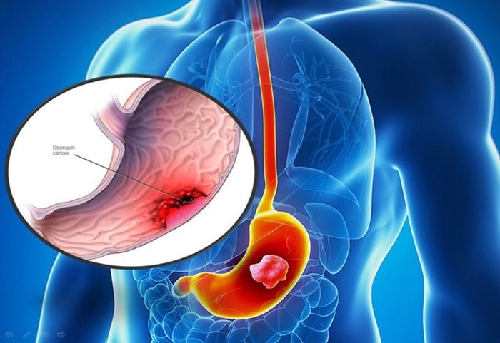 Ung Thư Dạ Dày: Nguy Hiểm và Đe Dọa Tính Mạng