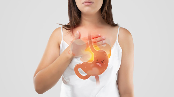 Trào ngược dạ dày thực quản là hiện tượng chất chứa trong dạ dày trào ngược lên thực quản