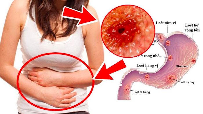 Hiểu rõ hơn về bệnh viêm dạ dày cấp