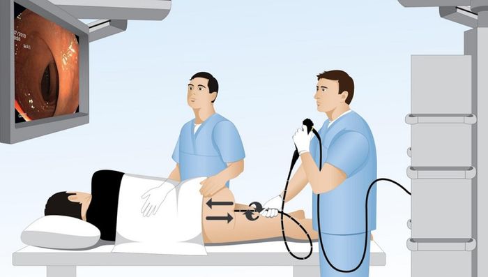 Sử dụng nội soi để phát hiện và loại bỏ sớm polyp đại tràng sigma.