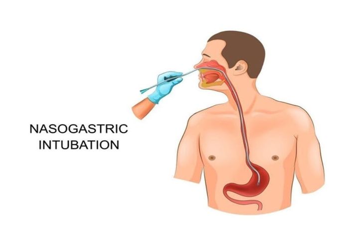 Đặt ống dạ dày để cung cấp dưỡng chất cho bệnh nhân