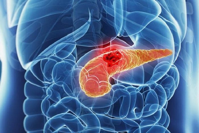 Bệnh nhân mắc viêm tụy cần được điều trị kịp thời và chính xác