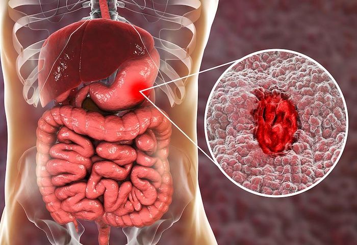 Nếu không điều chỉnh chế độ ăn uống và điều trị tích cực, viêm loét dạ dày có thể phát triển thành ung thư.
