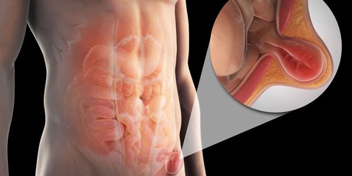 Bệnh thoát vị bẹn có nhiều nguyên nhân khác nhau