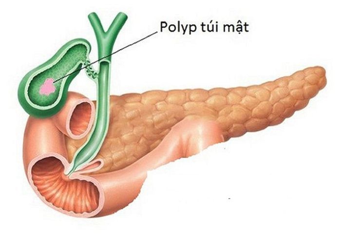 Polyp túi mật thường phát triển do sự chuyển hóa cholesterol không cân đối