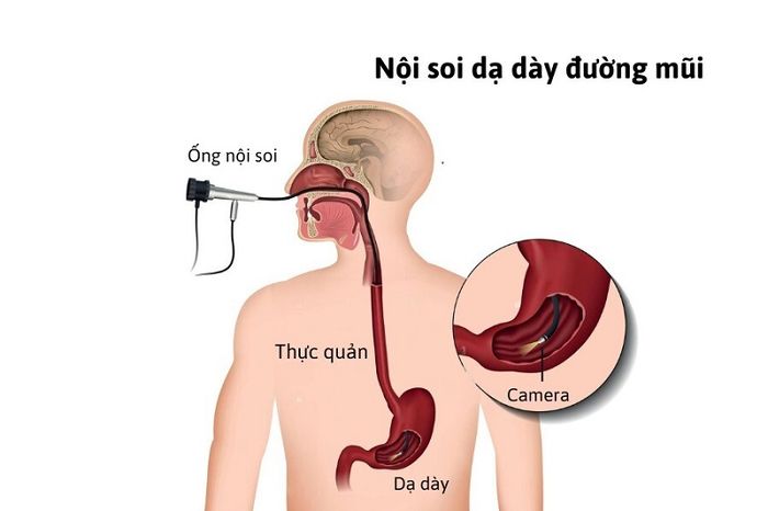 Mô phỏng cách thức thực hiện nội soi dạ dày qua đường mũi