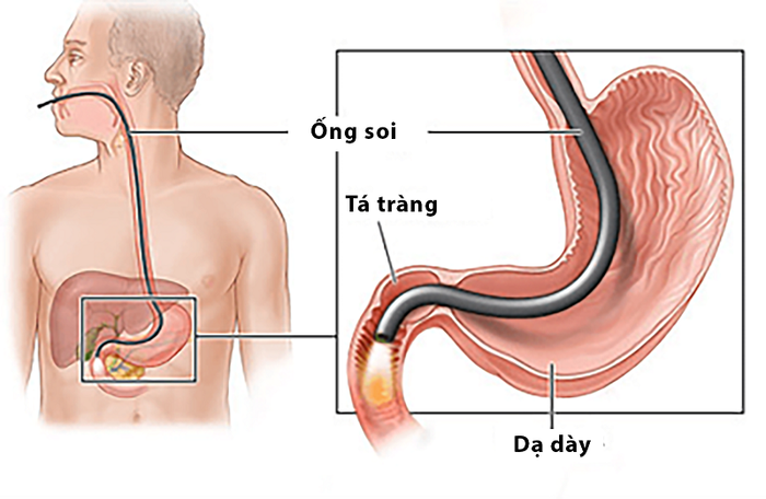 Mô phỏng việc thực hiện nội soi dạ dày qua đường miệng
