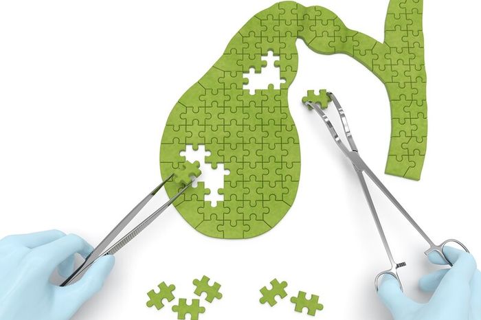 Polyp túi mật ác tính có thể phát triển thành ung thư.