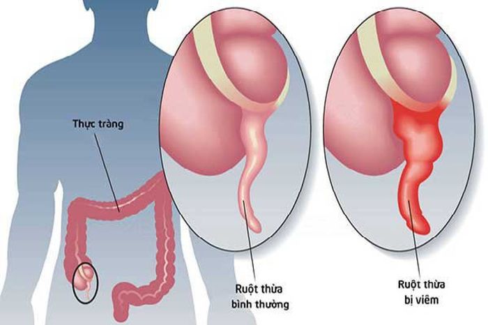 Đám quánh xung quanh ruột thừa có thể bảo vệ ngăn việc viêm lan rộng