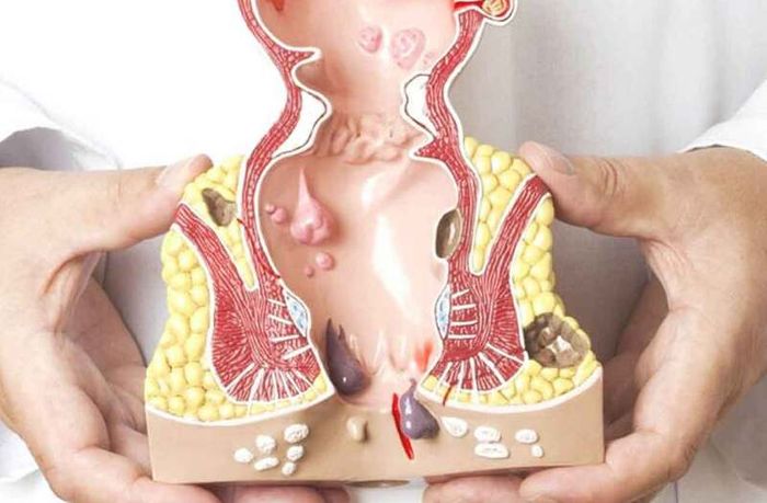 Trĩ nội ở mức độ 3 đã rơi ra ngoài hậu môn