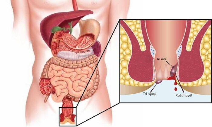 Bệnh trĩ là một vấn đề phổ biến gây ra nhiều đau đớn và phiền toái cho người bệnh