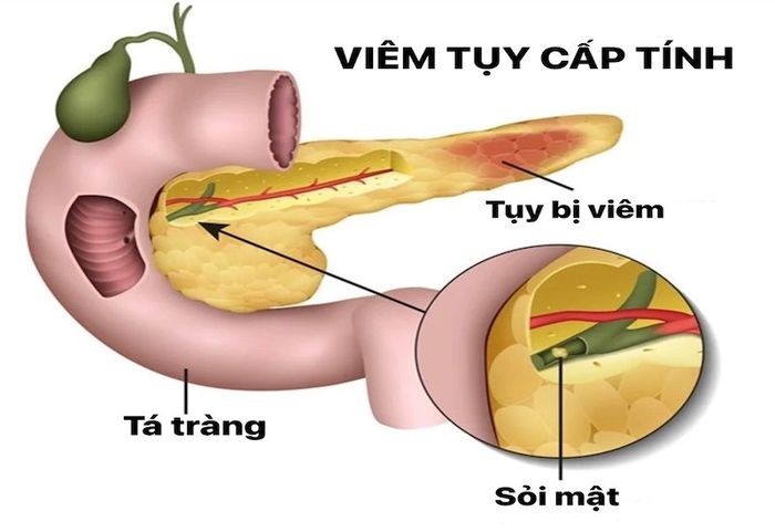 Minh họa tình trạng viêm tụy cấp do sỏi mật