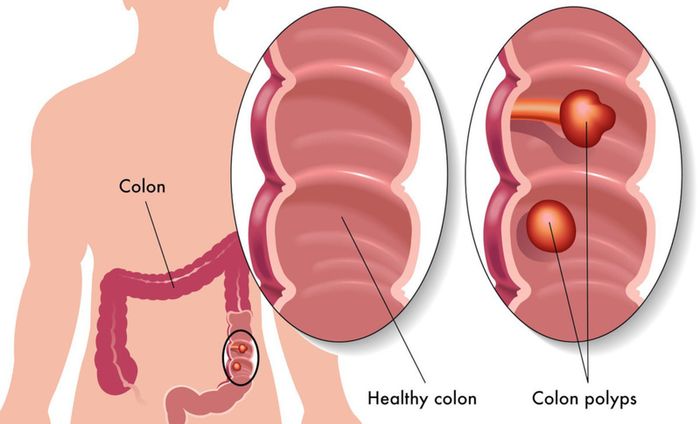 Polyp đại tràng là nguyên nhân gây ra chảy máu tiêu hóa