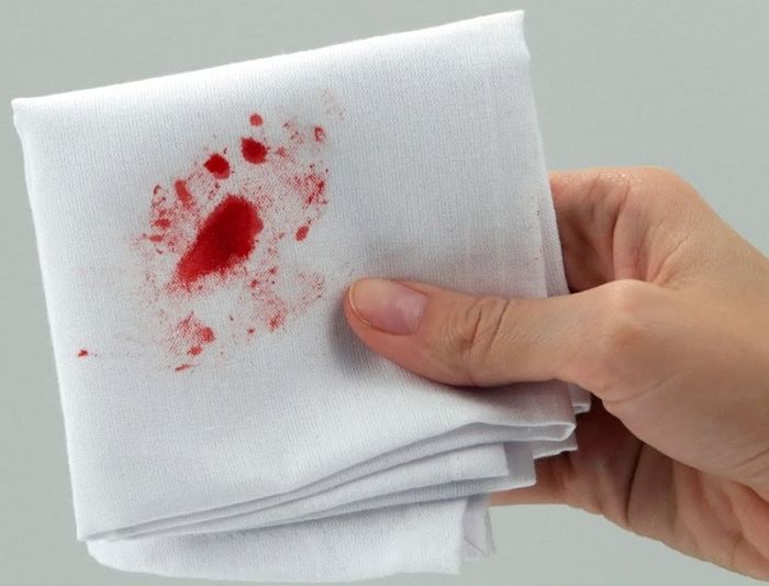 Máu chảy khi đi tiêu chính là dấu hiệu đặc trưng của bệnh trĩ nội giai đoạn 3.