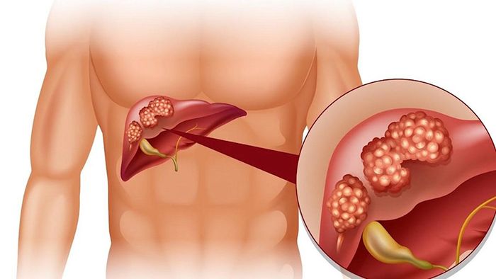 Đau bụng ở vùng trên rốn có thể là dấu hiệu cảnh báo của các vấn đề liên quan đến gan