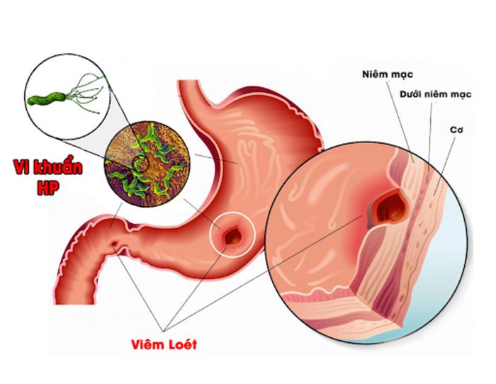 Viêm loét dạ dày gây đau bụng kèm theo cảm giác nóng và ợ hơi.