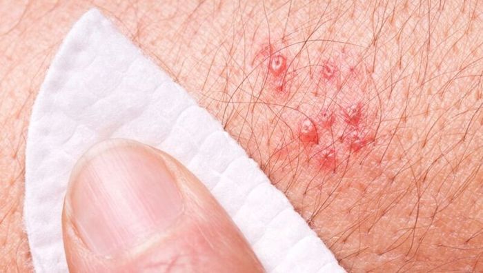 Đau bụng bên trái kèm theo triệu chứng ngoại da có thể là do zona thần kinh
