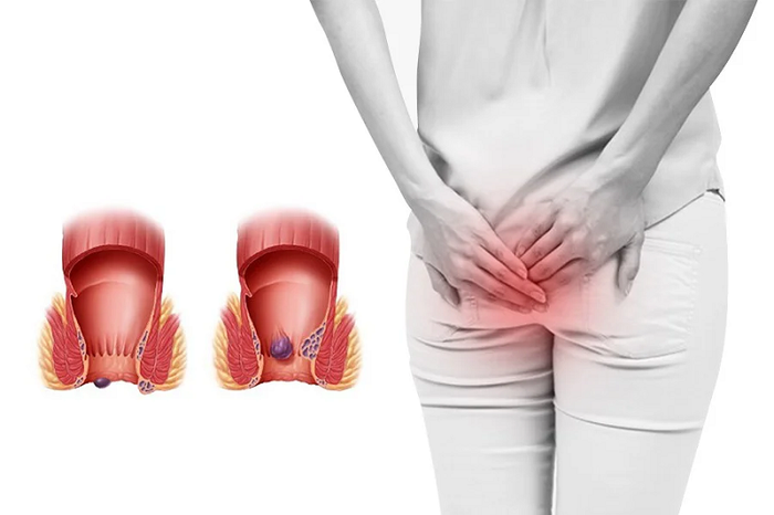 Cần phải phẫu thuật trĩ khi bệnh diễn biến từ cấp độ 3 trở lên.