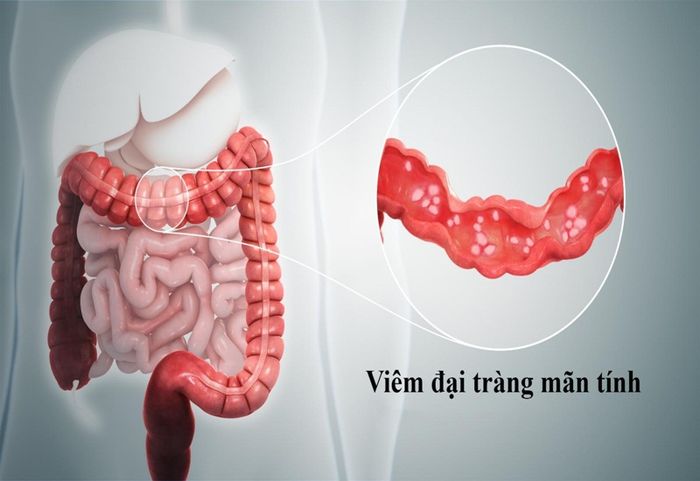 Triệu chứng đau đại tràng thường xuyên là dấu hiệu của bệnh gì?
