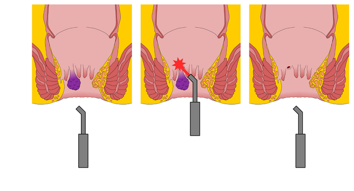 Phương pháp cắt trĩ bằng laser đang được sử dụng rộng rãi