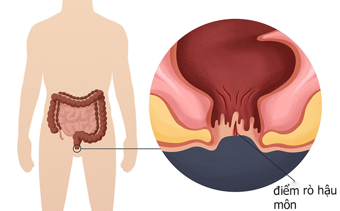 Rò Hậu Môn - Bệnh Lý Mang Tính Chất Nhiễm Khuẩn Mạn Tính