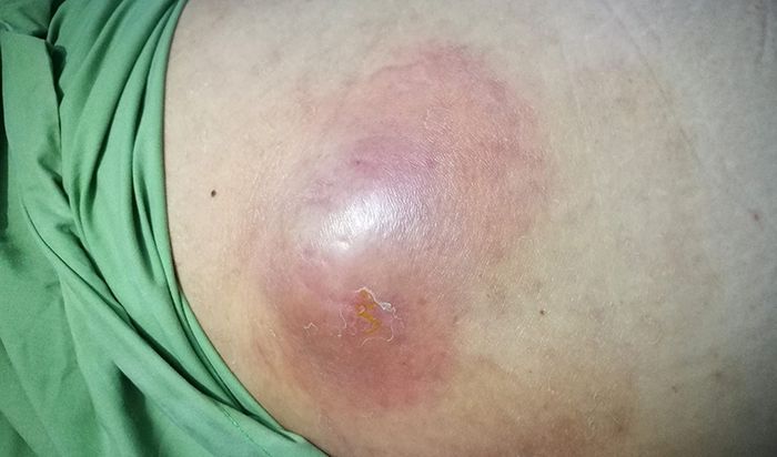 Quá trình thực bào của bạch cầu chống lại vi khuẩn là nguyên nhân gây ra áp xe.