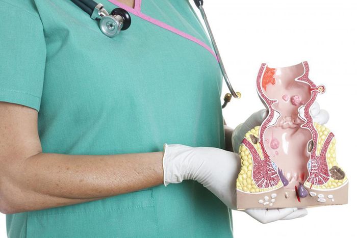 Người mắc trĩ ngoại thường phát triển một khối trĩ nhỏ tại rìa hậu môn.