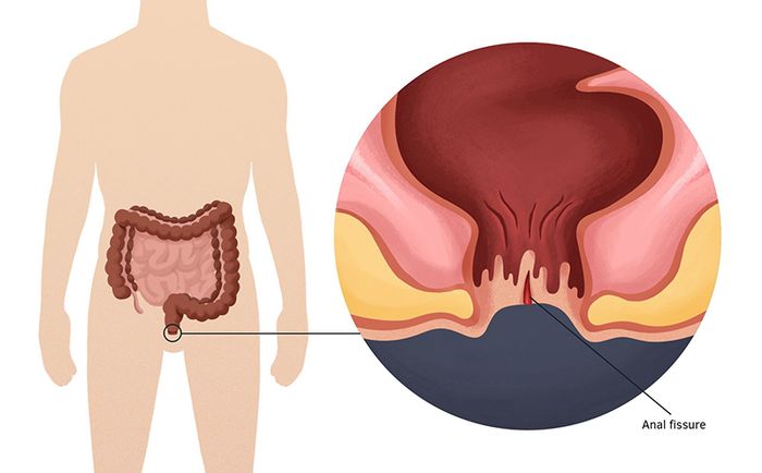 Rò hậu môn không chỉ ảnh hưởng vật lý mà còn tác động đến tâm lý của người mắc bệnh.