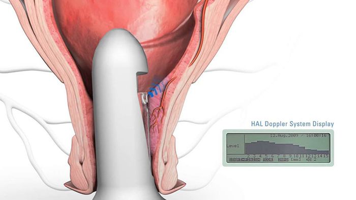 Hình ảnh cắt trĩ bằng kỹ thuật siêu âm Doppler