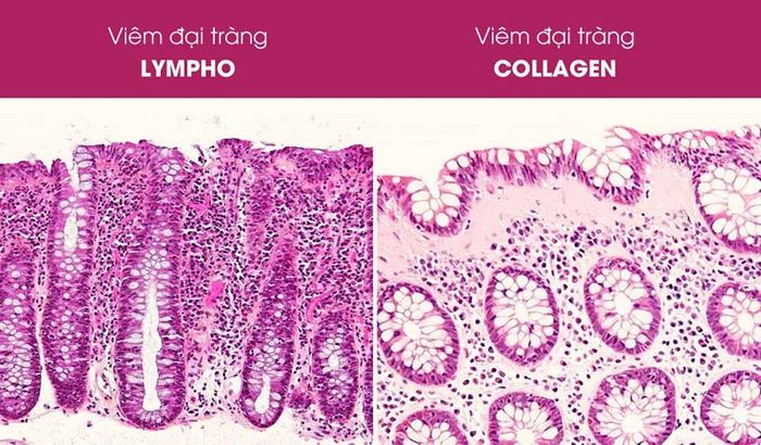 Hai dạng viêm đại tràng vi thể