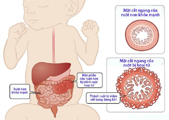 Viêm ruột hoại tử thường xảy ra ở trẻ sinh non