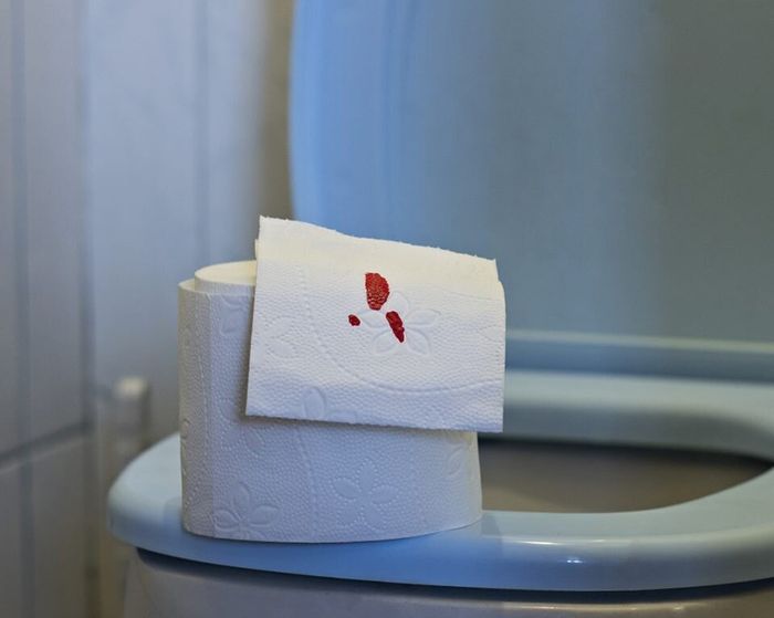 Dấu hiệu rõ ràng nhất của bệnh trĩ là chảy máu