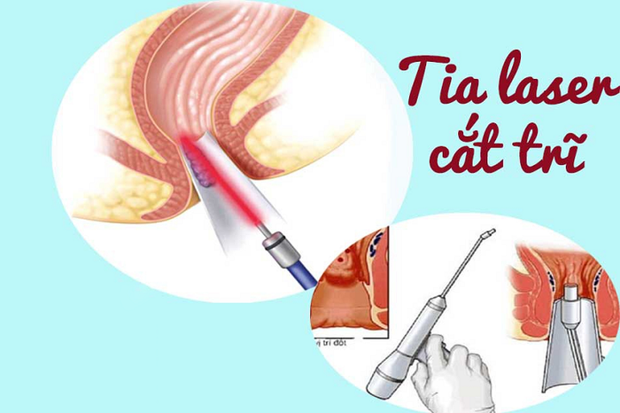 Phương pháp cắt trĩ nào là tốt nhất?