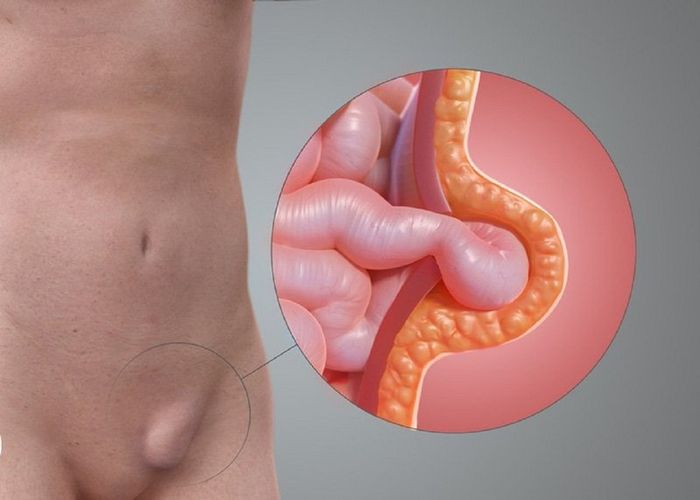 Tác động của thoát vị bẹn đối với sinh sản