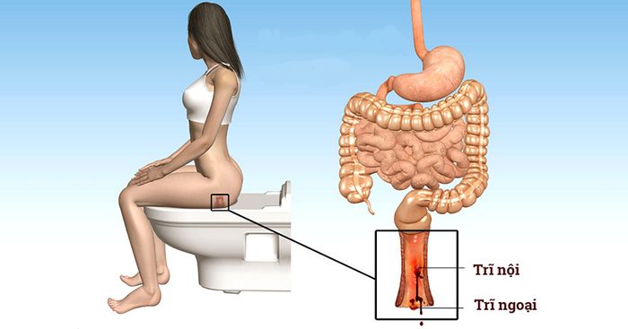 Bệnh trĩ được chia thành trĩ nội, trĩ ngoại, trĩ hỗn hợp tùy thuộc vào vị trí phát sinh búi trĩ.