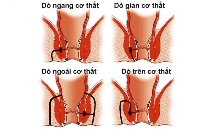 Dựa vào vị trí của các ổ rò, bệnh nhân có thể được chia thành các nhóm chính như trên