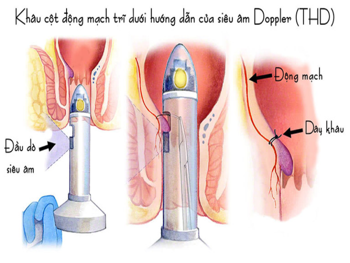 Dùng máy siêu âm Doppler để dò tìm vị trí của động mạch búi trĩ.