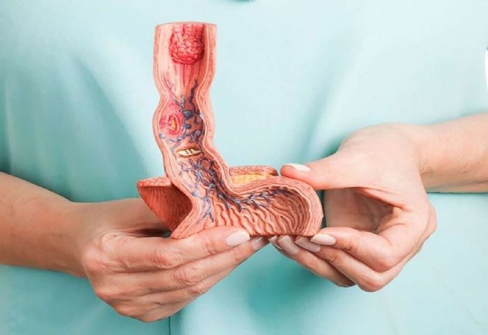 Khó thở do trào ngược dạ dày có thể gây ra nhiều biến chứng nghiêm trọng ở thực quản