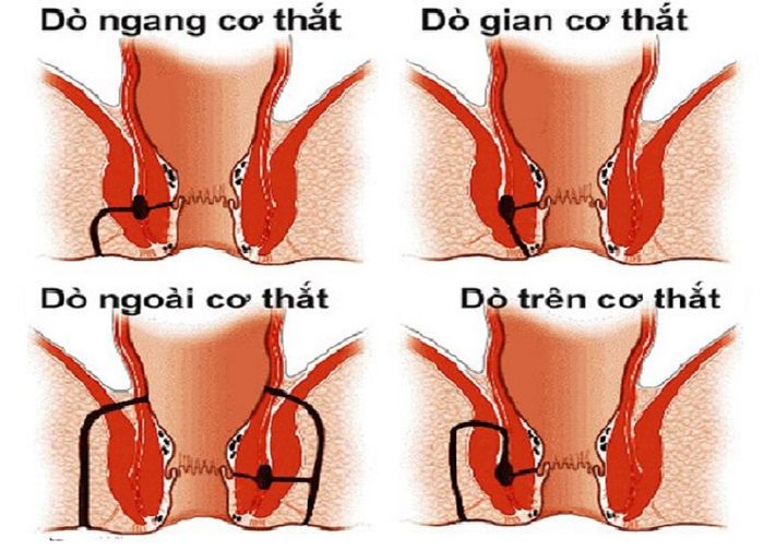 Hầu hết các trường hợp rò hậu môn đều bắt nguồn từ các ổ áp xe hậu môn.