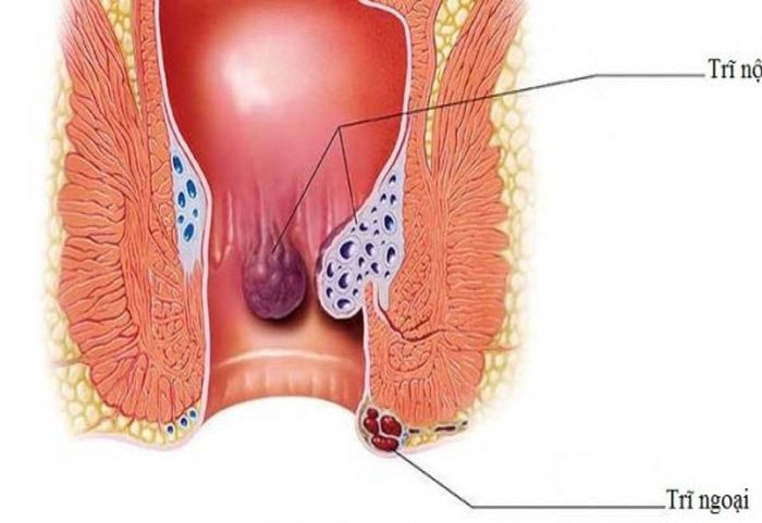 Tình trạng táo bón kéo dài gây ra bệnh trĩ