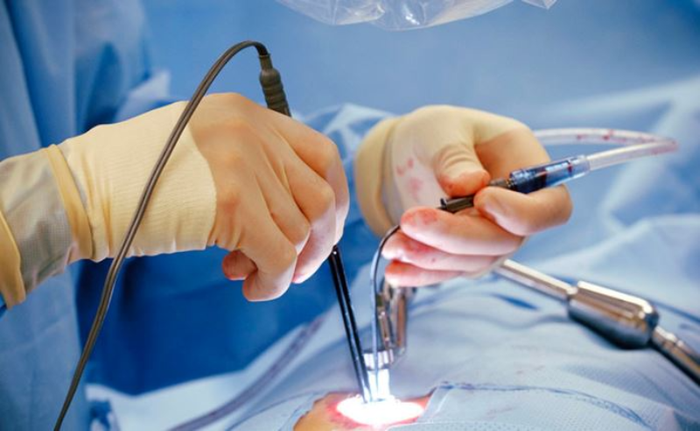 Phương pháp phẫu thuật cắt trĩ bằng sóng cao tần HCPT