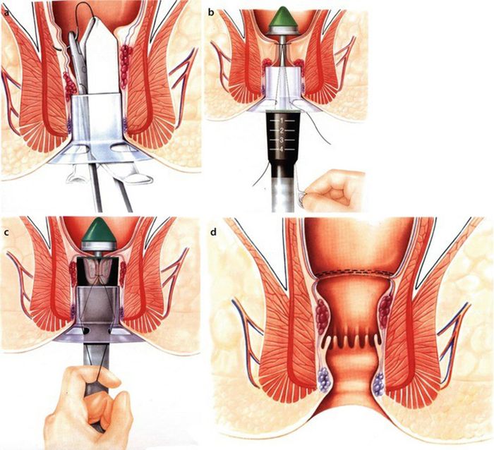 Longo - một trong những phương pháp cắt trĩ tiên tiến ngày nay