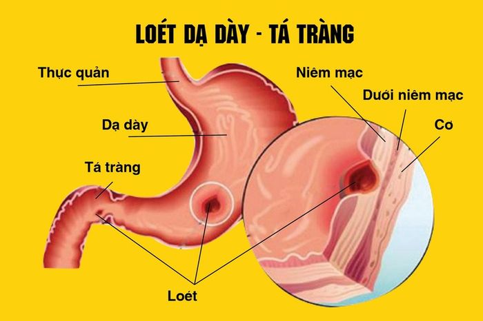 Yếu tố có thể làm tổn thương niêm mạc dạ dày