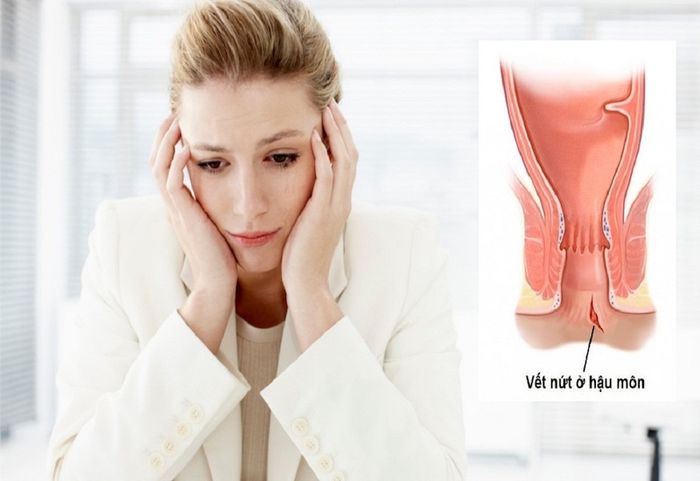 Khó khăn trong việc đi đại tiện sau khi phẫu thuật trĩ có thể là do hậu quả của chứng hẹp ống hậu môn do vết thương mổ.