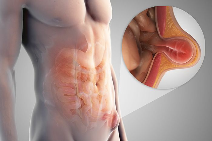 Thoát vị bẹn thường xảy ra nhiều hơn ở nam giới