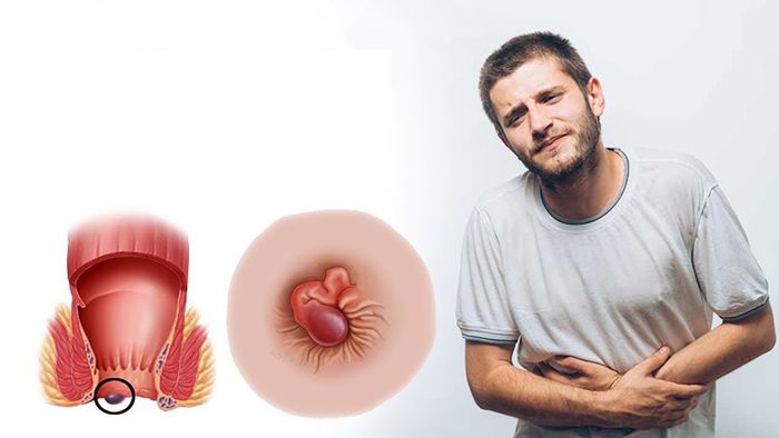 Bệnh trĩ ngoại có nguy hiểm không?