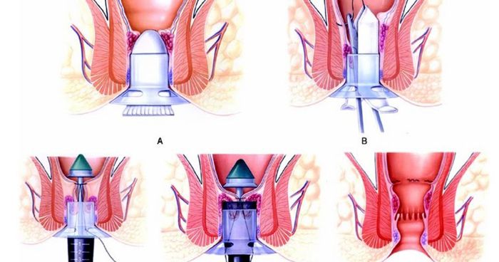 Phương pháp Longo là một trong những cách chữa trị bệnh trĩ hiệu quả mà không gây đau đớn