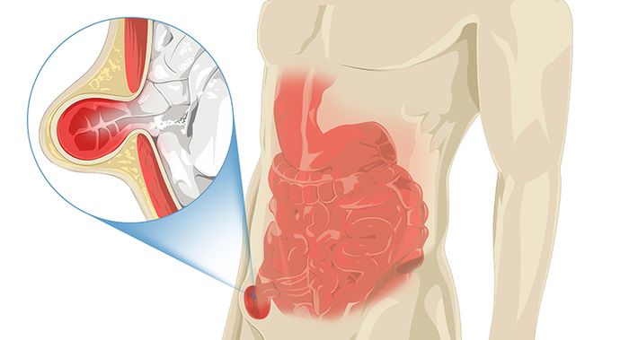 Thoát vị ổ bụng trực tiếp và thoát vị ổ bụng gián tiếp là phân biệt dễ dàng nhất
